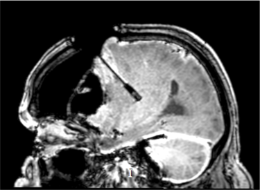 Intra-operative MR image showing precise needle positioning towards a target in the brain during a cadaver study